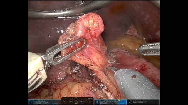 Plastica antireflusso robotica secondo Nissen Rossetti