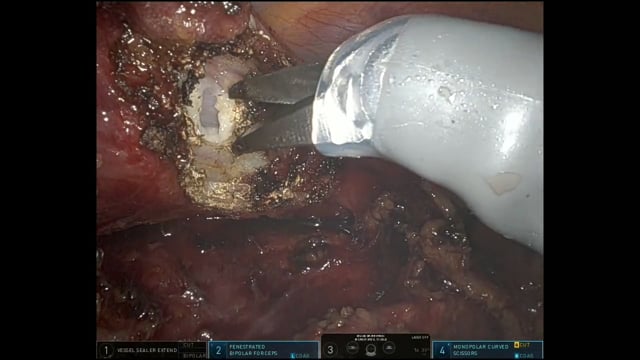 Isolamento dell'esofago toracico con tecnica robotica