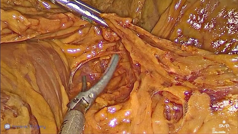 Gastrectomia. Simone Giacopuzzi