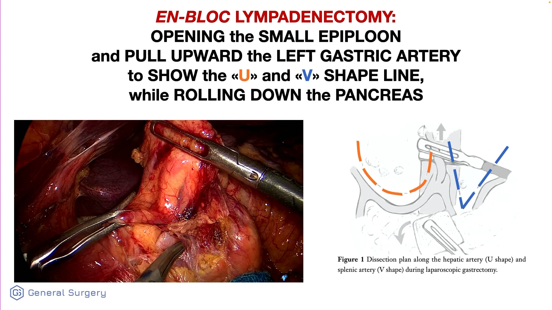 Minimally invasive gastrectomy with en-bloc D2. Simone Giacopuzzi