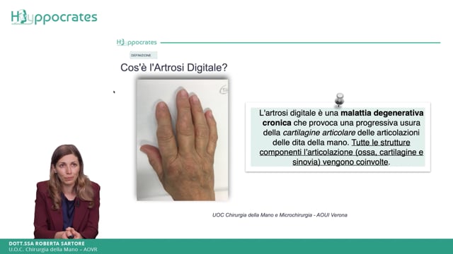 Artrosi digitale - Roberta Sartore