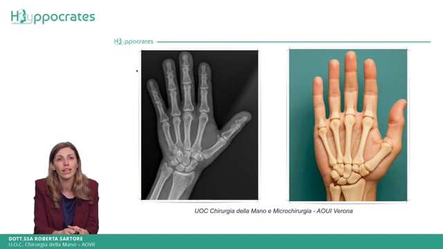 Artrosi di polso. Panoramica - Roberta Sartore