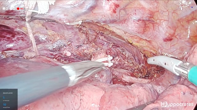 Esofagectomia MIE sec. Mc Keown a tre tempi. Paziente in posizione prona - Tempo toracico toracoscopico