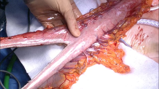 Esofagectomia MIE sec. Mc Keown a tre tempi. Tempo addominale laparoscopico e tempo cervicale con incisione al collo