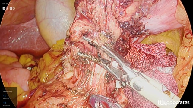 Gastrectomia subtotale mininvasiva