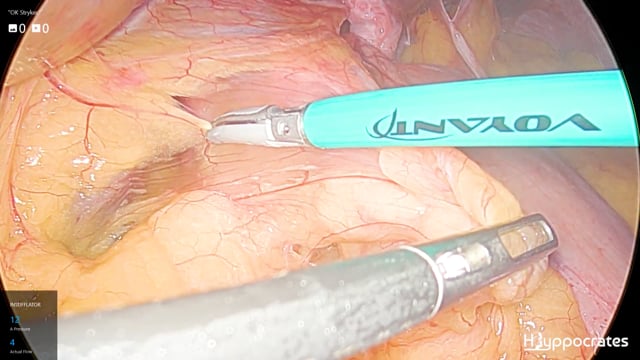 Riparazione di ernia jatale per via laparoscopica