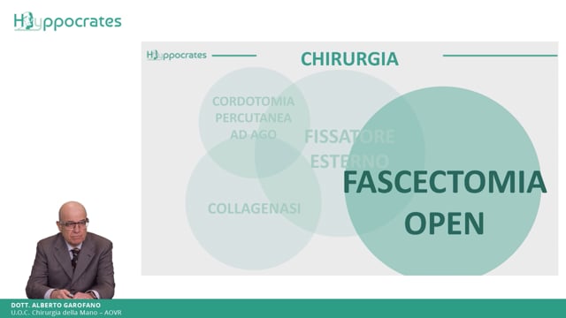 Il morbo di Dupuytren. Fascectomia open - Alberto Garofano