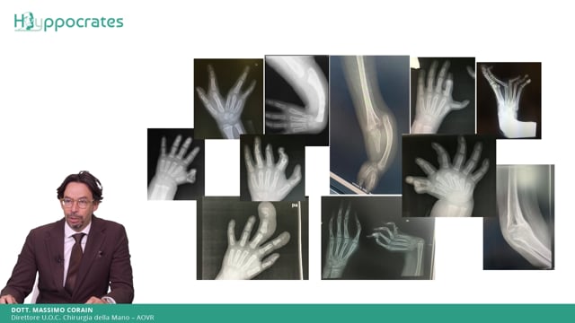Le malformazioni congenite di mano e polso - Massimo Corain